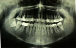 Invisalign - Ortodonzia invisibile